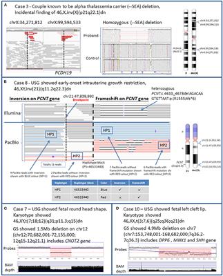 Evaluating the Clinical Utility of Genome Sequencing for Cytogenetically Balanced Chromosomal Abnormalities in Prenatal Diagnosis